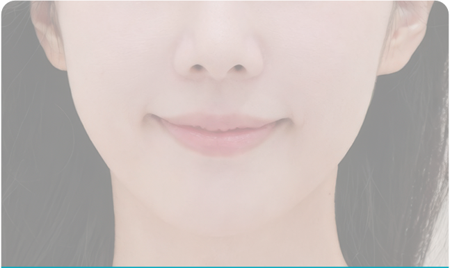 낮아진 헤어라인으로 정리된 이마 비율